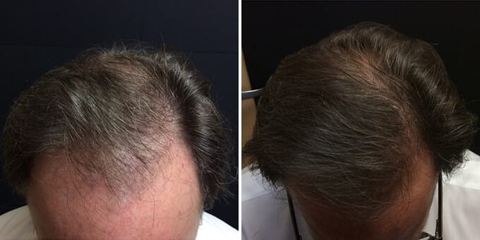 Male Hair Restoration Results - Before and After
