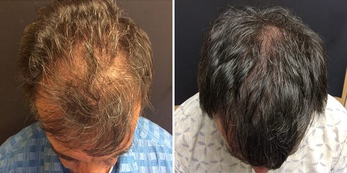 Hair Restoration with PHP Therapy Results - Before and After