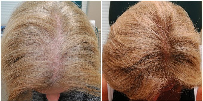 Female Hair Restoration Results - Before and After